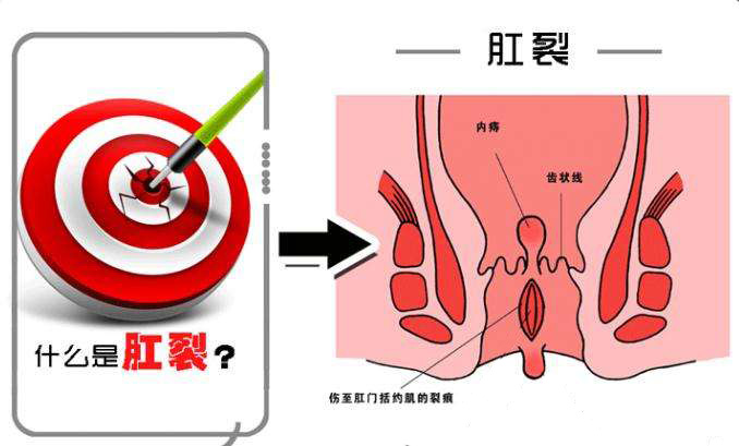 咨询医师了解自己肛裂的原因 &ensp